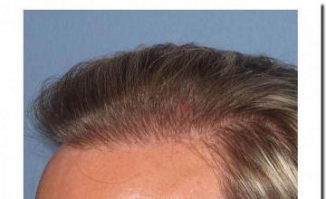 Hair restoration procedure results