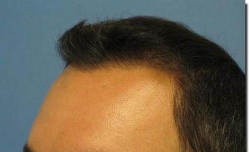 Hair restoration procedure results