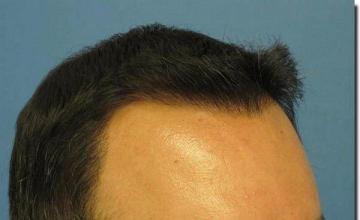 Hair restoration procedure results