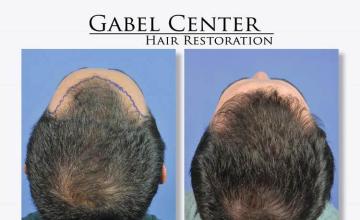 Back view before and after hair transplantation photos