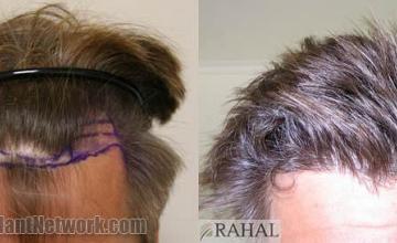 Hair restoration procedure before and after pictures