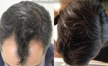 Hair transplantation surgery before and after photos