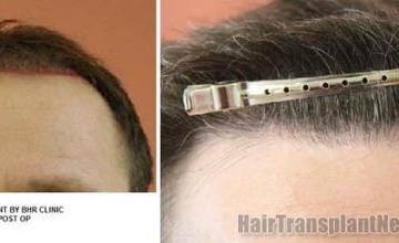 Hair restoration procedure before and after results