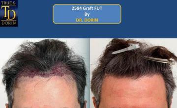 Hair restoration surgery before and after photos