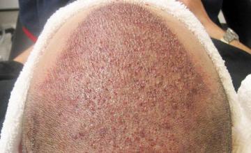 Hair transplantation surgery before and after photos