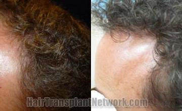 Hair restoration procedure result images