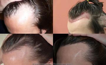 Hair transplantation surgery before and after pictures