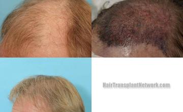 Hair restoration procedure before and after pictures