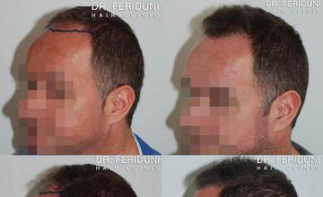 Hair transplantation surgery before and after pictures