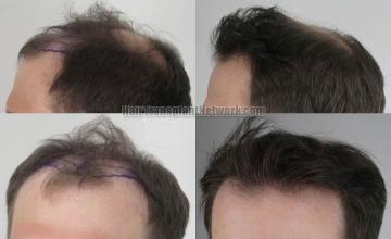 Hair transplantation surgery before and after pictures