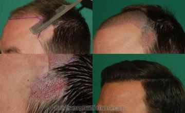 Hair transplantation surgery before and after pictures