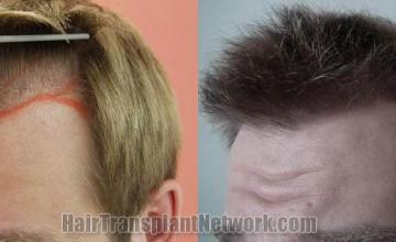 Surgical hair transplantation result photographs