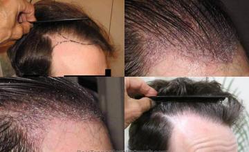 Hair restoration procedure before and after pictures