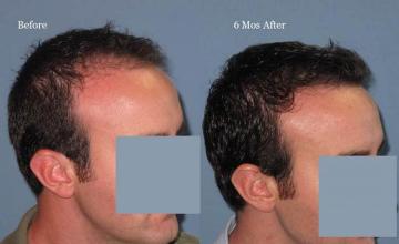 Hair transplantation surgery before and after pictures