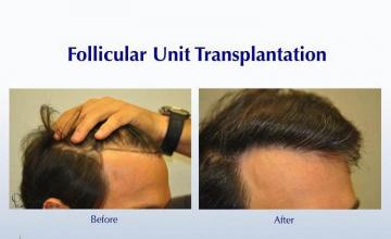 Hair transplantation surgery before and after images