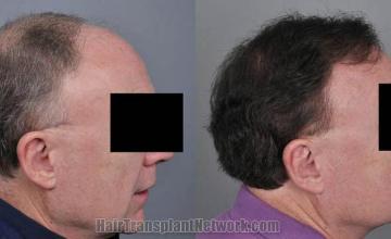 Hair transplantation surgery before and after images