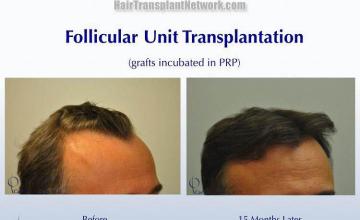 Hair transplantation surgery before and after photos