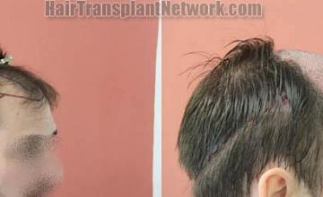 Hair transplantation surgery before and after pictures