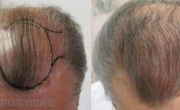 Top view of hair restoration results