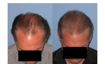 Top view pictures before and after hair restoration