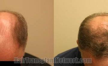 Hair transplantation surgery before and after images