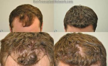 Hair restoration procedure before and after results