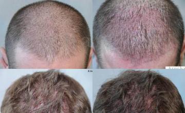 Hair restoration procedure before and after results