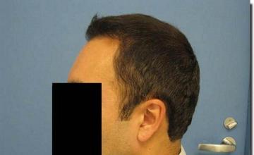 Hair restoration procedure results