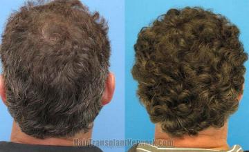 Hair restoration procedure results