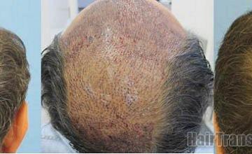 Crown view of hair transplant patient's results