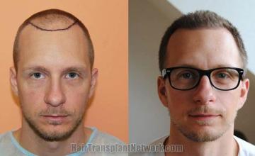 Hair restoration procedure before and after results