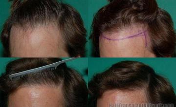 Hair restoration pictures showing left angle before and after