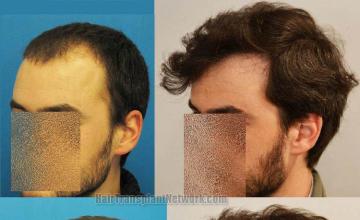 Hair restoration procedure before and after results