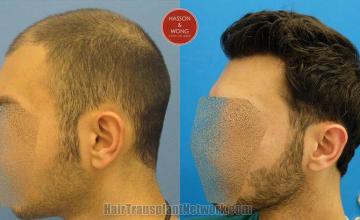 Hair transplantation surgery before and after pictures