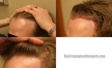 Hair restoration procedure before and after pictures