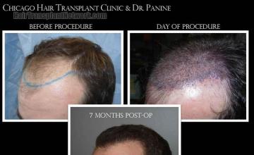 Hair transplantation surgery before and after images