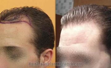 Hair transplantation surgery before and after pictures