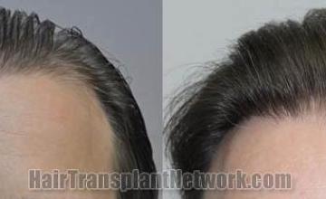 Hair restoration procedure before and after results