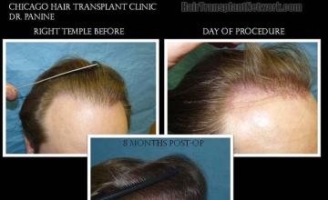 Hair transplantation surgery before and after images