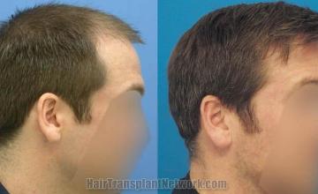 Hair restoration procedure before and after results