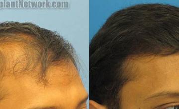 Hair transplantation surgery before and after images