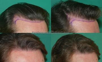 Hair restoration procedure before and after results