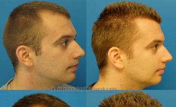 Hair transplantation surgery before and after images