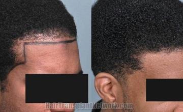 Hair transplantation surgery before and after photos