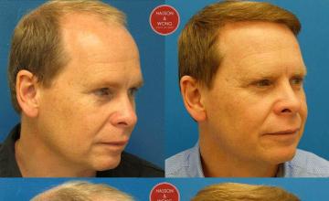 Hair restoration procedure before and after pictures