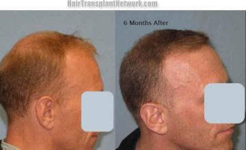 Hair transplantation surgery before and after images