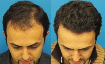 Hair restoration surgery before and after photos