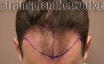 Top view showing hair restoration results