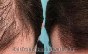 Hair restoration procedure before and after results