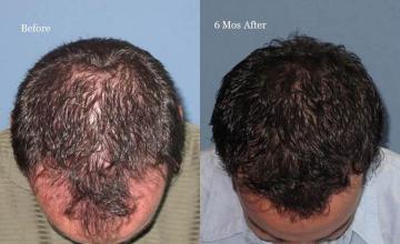 Hair restoration procedure before and after pictures